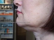 Before-Dermalift