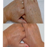 Pigmentation hands