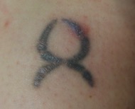 safe tattoo removal